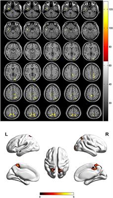 Altered Spontaneous Brain Activity in Patients With Diabetic Osteoporosis Using Regional Homogeneity: A Resting-State Functional Magnetic Resonance Imaging Study